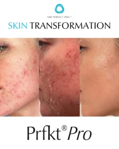 CLINICCARE Glow Peel